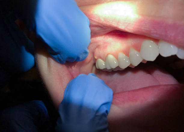Best Dentist for Tooth Abscess  in Bellmawr, NJ